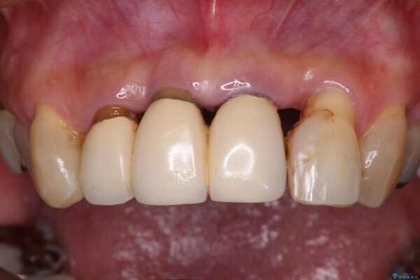 不具合ばかりの前歯　前歯のオールセラミックブリッジ 治療前画像