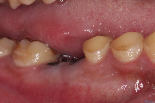 放置した虫歯　奥歯のオールセラミックブリッジ治療 治療前画像