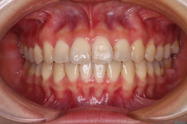 前歯のクロスバイト　ワイヤー装置を併用したインビザライン矯正 治療後画像