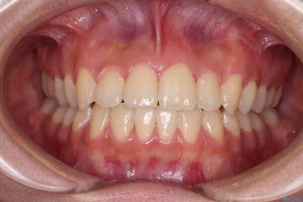 前歯のクロスバイトを短期間で解消　目立たないワイヤー矯正 アフター