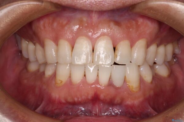 内側にある歯が干渉する　上顎前歯の部分矯正 アフター