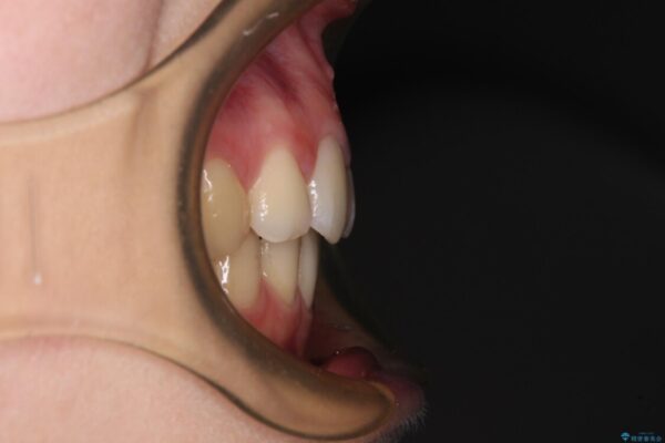 【モニター】口が閉じにくい　目立たないワイヤー装置で口元を引っ込める 治療後画像