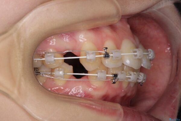 【モニター】口が閉じにくい　目立たないワイヤー装置で口元を引っ込める 治療途中画像