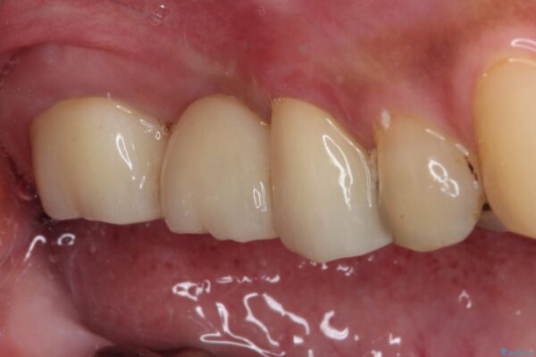 放置した奥歯の虫歯　セラミックブリッジによる補綴治療 治療後画像
