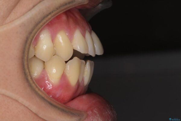 隙間が空いて突出した前歯を治したい　ワイヤー装置による抜歯矯正 ビフォー