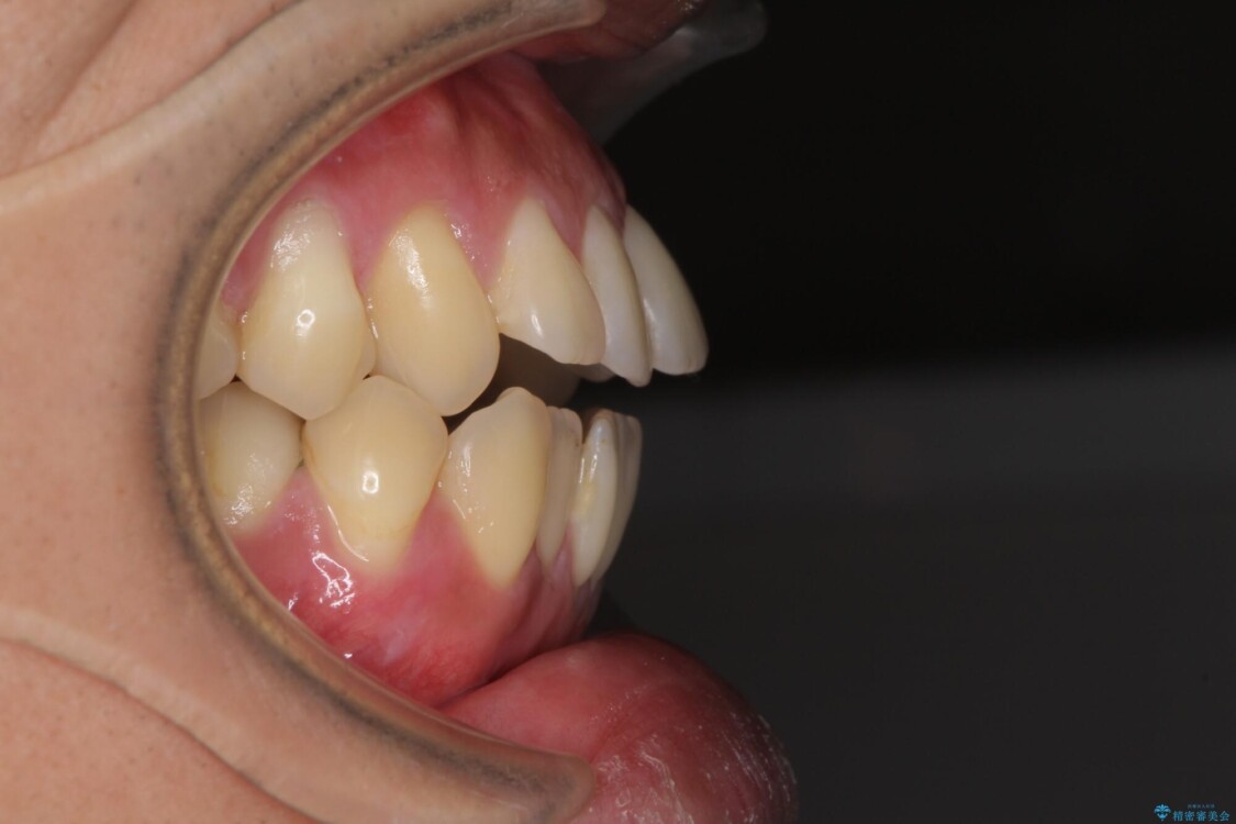 隙間が空いて突出した前歯を治したい　ワイヤー装置による抜歯矯正 治療前
