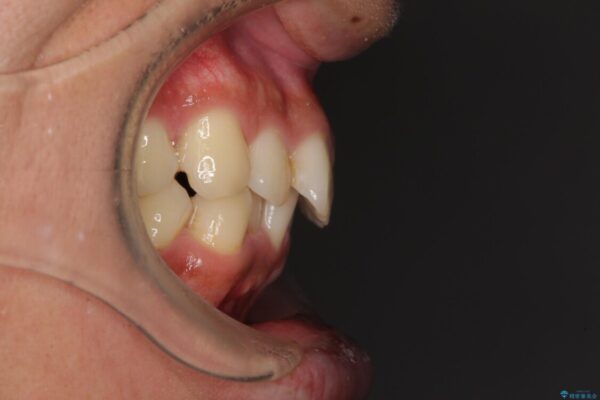 前歯のデコボコをスッキリ改善　インビザライン矯正 治療前画像