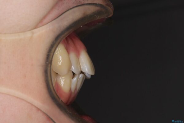 前歯のデコボコを治したい　ワイヤー装置でお手軽に矯正治療 治療前画像