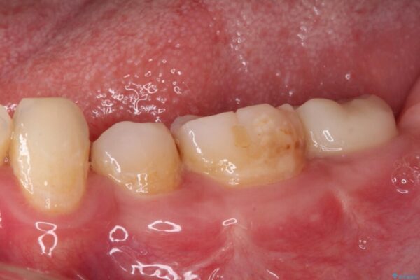 部分矯正を併用した奥歯のインプラント治療 治療後画像