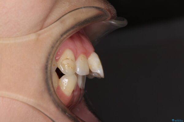出っ歯による口の閉じにくさを治したい　ワイヤー装置を用いた抜歯矯正 ビフォー