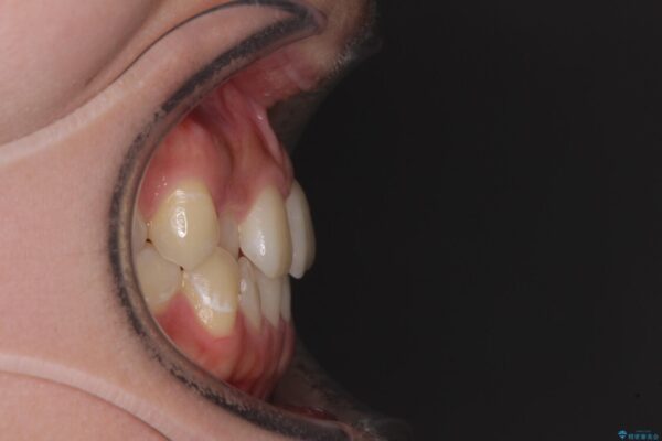 前歯のクロスバイトを短期間で解消　目立たないワイヤー矯正 治療前画像