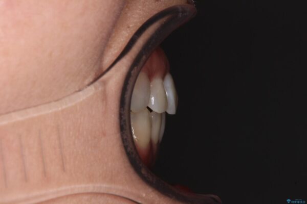 極端な上下前歯の開咬を改善　オープンバイトのインビザライン矯正 治療後画像