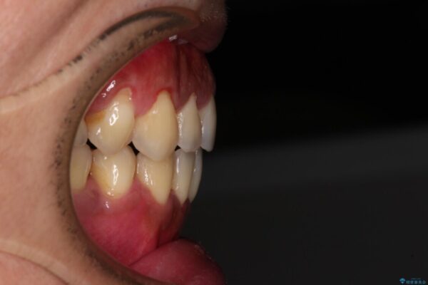 隙間が空いて突出した前歯を治したい　ワイヤー装置による抜歯矯正 アフター