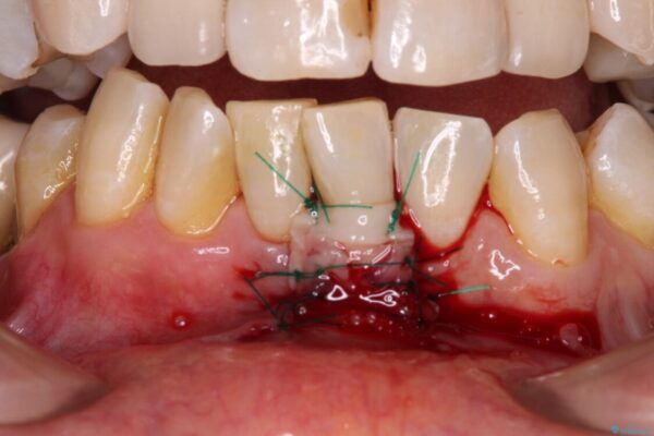 歯根が見えてしみる　歯肉移植による歯肉退縮の改善 治療途中画像