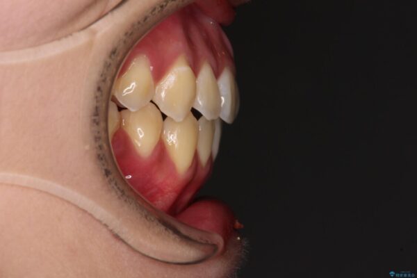 受け口と開咬を急速拡大装置とワイヤー装置で改善 治療後画像
