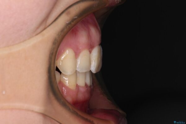 出っ歯による口の閉じにくさを治したい　ワイヤー装置を用いた抜歯矯正 アフター
