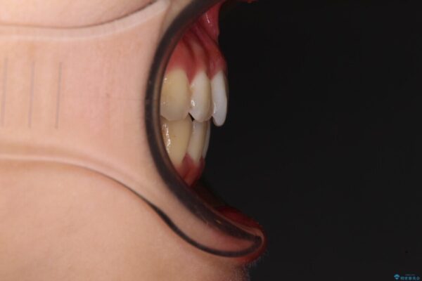 前歯のクロスバイト　ワイヤー装置を併用したインビザライン矯正 治療後画像