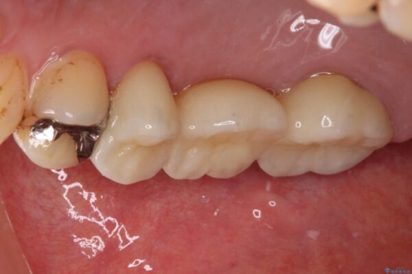 放置した奥歯の虫歯　セラミックブリッジによる補綴治療 治療後画像