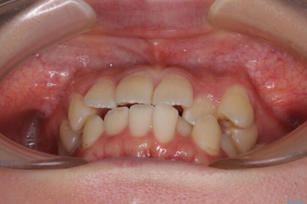 【モニター】八重歯と前歯のクロスバイト　ワイヤーを併用しインビザラインで矯正治療 治療前画像