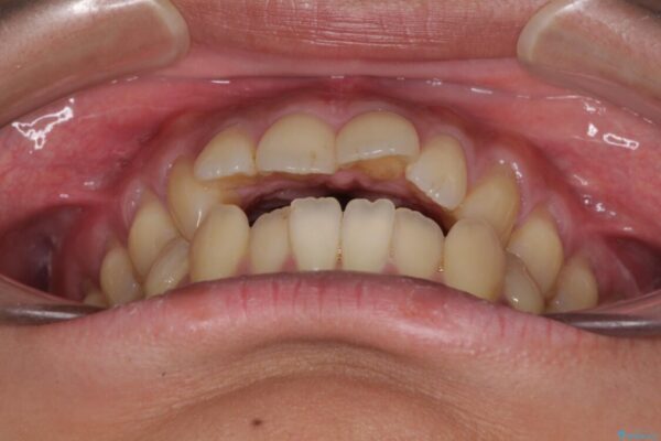 隙間が空いて突出した前歯を治したい　ワイヤー装置による抜歯矯正 治療前画像
