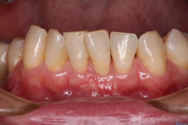 歯根が見えてしみる　歯肉移植による歯肉退縮の改善 治療後画像