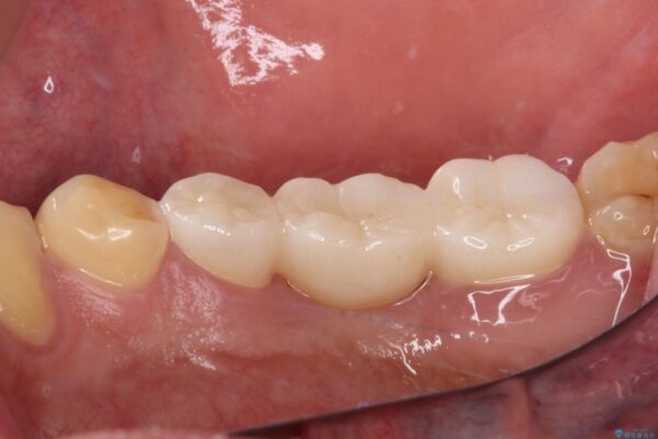 放置した虫歯　奥歯のオールセラミックブリッジ治療 治療後画像