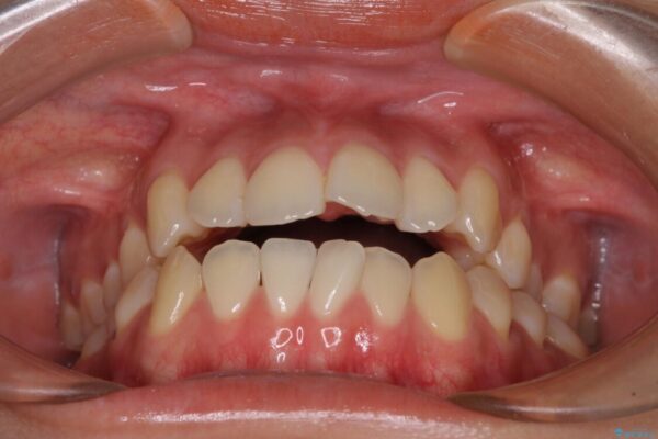 受け口と開咬を急速拡大装置とワイヤー装置で改善 治療前画像