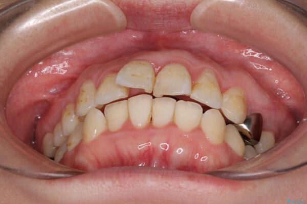 出っ歯による口の閉じにくさを治したい　ワイヤー装置を用いた抜歯矯正 治療前画像