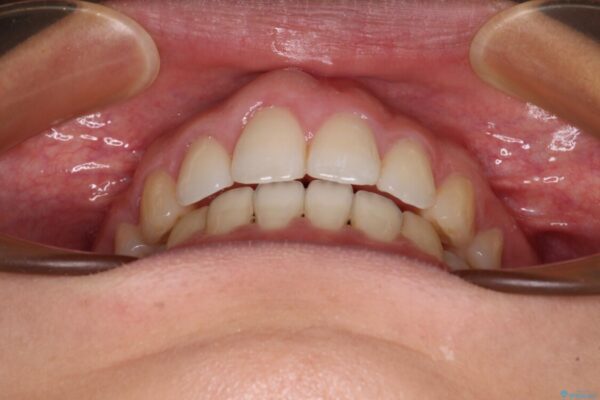 前歯の出っ歯と口の閉じにくさが気になる　目立たないワイヤー装置での抜歯矯正 治療後画像