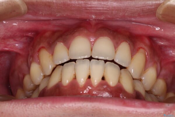 隙間が空いて突出した前歯を治したい　ワイヤー装置による抜歯矯正 治療後画像