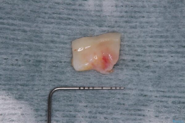 歯根が見えてしみる　歯肉移植による歯肉退縮の改善 治療前画像