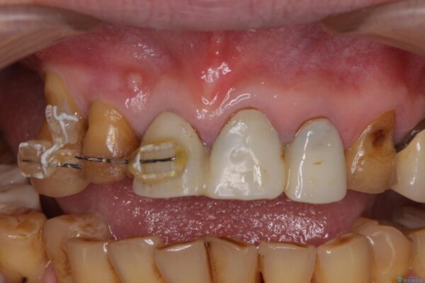 治療途中で放置してしまった前歯　オールセラミッククラウンによる補綴治療 治療前画像