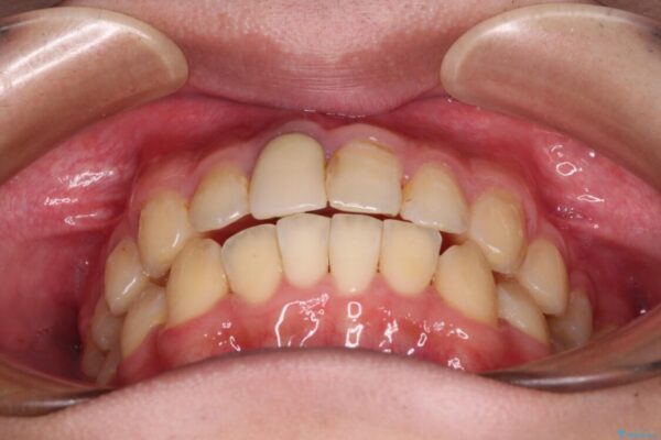 前歯のデコボコを治したい　インビザライン矯正治療 治療途中画像