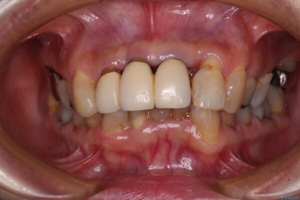 不具合ばかりの前歯　前歯のオールセラミックブリッジ 治療前画像