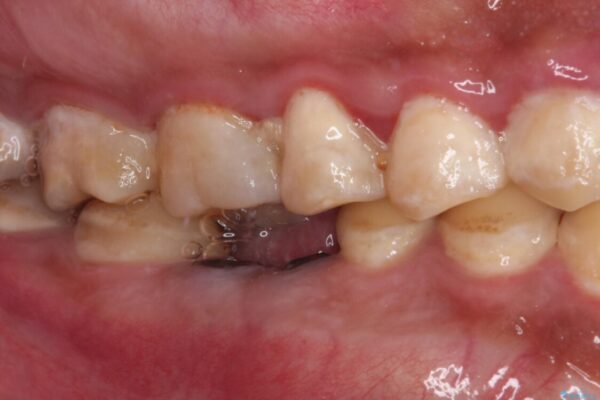 放置した虫歯　奥歯のオールセラミックブリッジ治療 治療前画像