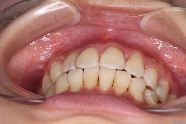 デコボコで磨きにくい前歯をスッキリと　インビザライン矯正 治療途中画像