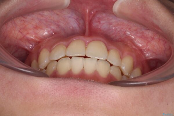 前歯のクロスバイトを短期間で解消　目立たないワイヤー矯正 治療後画像
