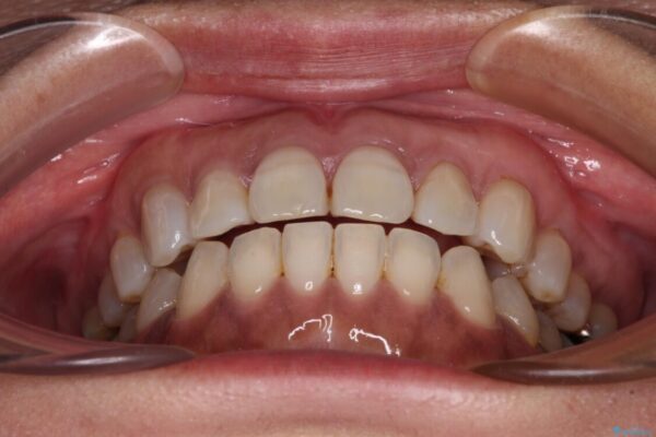 極端な上下前歯の開咬を改善　オープンバイトのインビザライン矯正 治療後画像