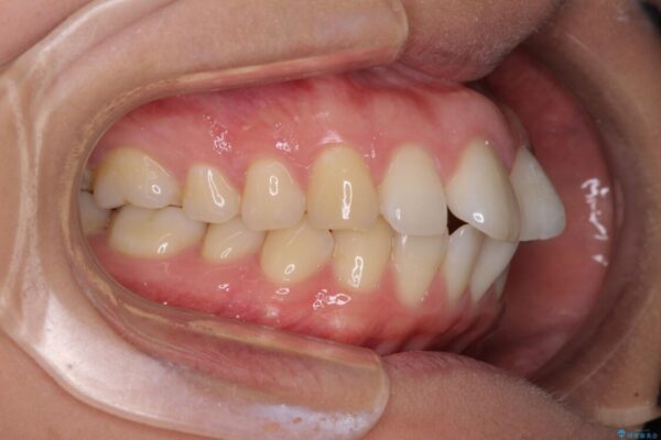 前歯の出っ歯と口の閉じにくさが気になる　目立たないワイヤー装置での抜歯矯正 治療前画像