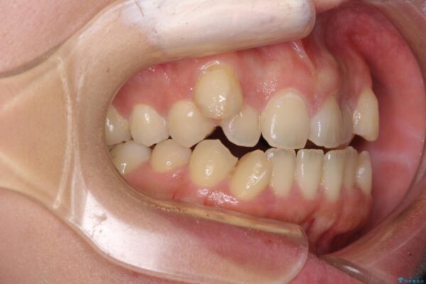 八重歯を抜歯矯正でスッキリと　メタルブラケットでの矯正治療 治療前画像
