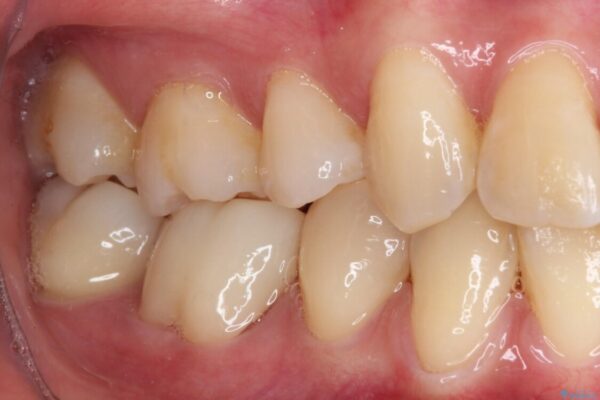 歯が欠けてしみる　オールセラミッククラウンによる虫歯治療 治療後画像