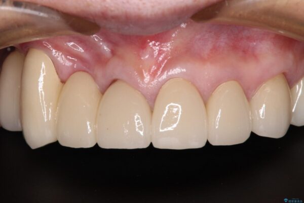 治療途中で放置してしまった前歯　オールセラミッククラウンによる補綴治療 治療後画像
