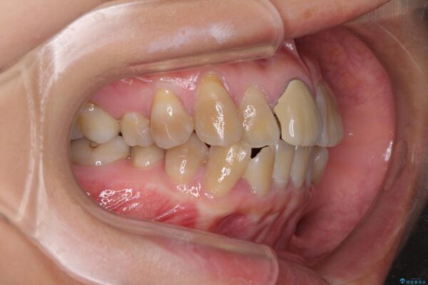 八重歯とクロスバイト　目立たないワイヤー装置での抜歯矯正 治療前画像