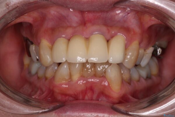不具合ばかりの前歯　前歯のオールセラミックブリッジ 治療後画像