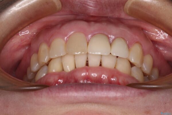 前歯のインプラント治療　折角なので矯正治療できれいな歯並びに 治療後画像