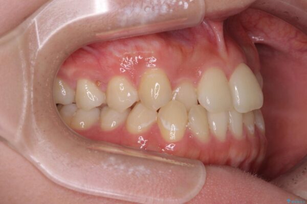 前歯のクロスバイトを短期間で解消　目立たないワイヤー矯正 治療前画像