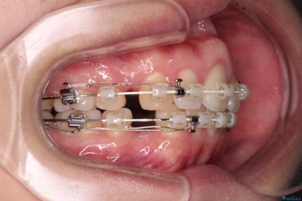 前歯の出っ歯と口の閉じにくさが気になる　目立たないワイヤー装置での抜歯矯正 治療途中画像