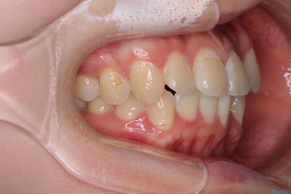 【モニター】八重歯と前歯のクロスバイト　ワイヤーを併用しインビザラインで矯正治療 治療前画像