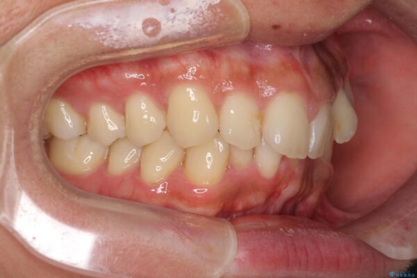 前歯のデコボコをスッキリ改善　インビザライン矯正 治療前画像