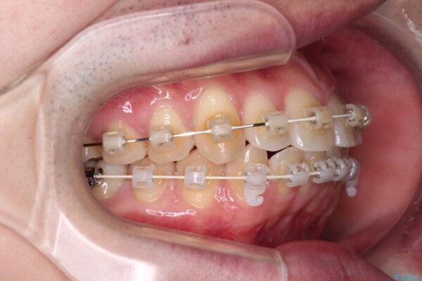 前歯のデコボコを治したい　ワイヤー装置でお手軽に矯正治療 治療途中画像